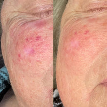 Load image into Gallery viewer, Facial Vessel Treatment- Osage Beach Office