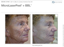 Load image into Gallery viewer, Photofacial + MicroLaser Peel- Package of 2- Osage Beach Office