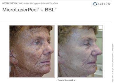 Photofacial + MicroLaser Peel- Osage Beach Office