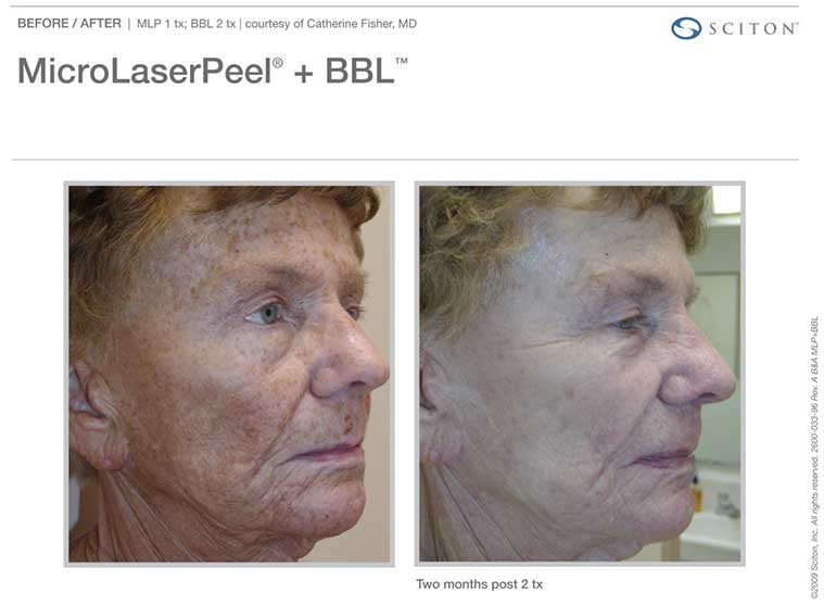 Photofacial + MicroLaser Peel- Package of 2- Osage Beach Office