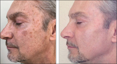 Halo by Sciton- Full Face | Neck | Chest Treatment- Osage Beach