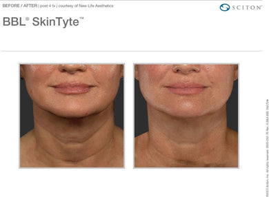 Skin Tyte of the Neck- Series of 3- Rolla Office