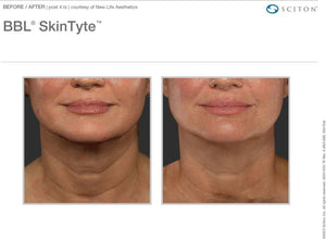 Skin Tyte of the Neck- Series of 3- Rolla Office