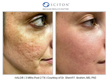 Load image into Gallery viewer, Halo by Sciton- Full Face Treatment- Osage Beach