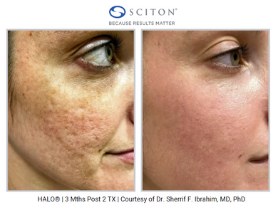 Halo by Sciton- Full Face and Neck Treatment- Osage Beach