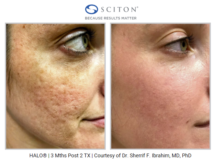 Halo by Sciton- Full Face and Neck Treatment- Osage Beach