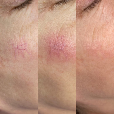 Facial Vessel Treatment- Osage Beach Office