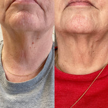 Load image into Gallery viewer, Potenza RF Microneedling Full Face x3 - Osage Beach