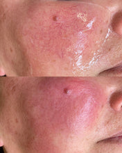 Load image into Gallery viewer, Facial Vessel Treatment- Osage Beach Office