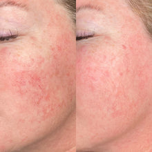Load image into Gallery viewer, Facial Vessel Treatment- Osage Beach Office