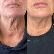 Load image into Gallery viewer, Potenza RF Microneedling Full Face x3 - Osage Beach