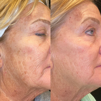 Total Skin Solution- Ultra + Potenza Combo for face- Osage Beach