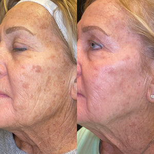 LaseMD Ultra- Full Face- Osage Beach