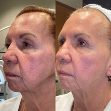 Load image into Gallery viewer, Potenza RF Microneedling Full Face x3 - Osage Beach