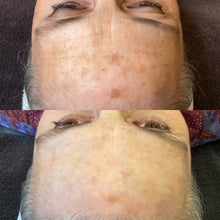 Load image into Gallery viewer, BBL Photofacial + Ultra- Osage Beach Office