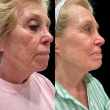 Load image into Gallery viewer, ProFractional Resurfacing- Osage Beach