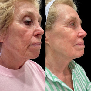 ProFractional Resurfacing- Osage Beach