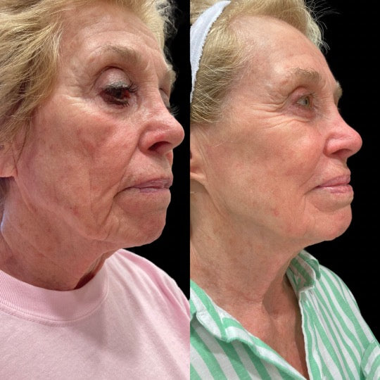 ProFractional Resurfacing- Waynesville