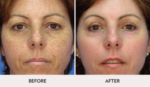 Micro Laser Peel- Osage Beach