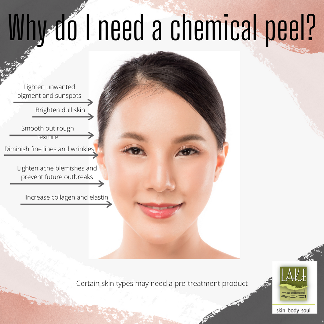 TCA Mineral Chemical Peel with Mini Facial- Rolla Office