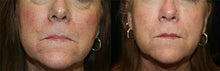 Load image into Gallery viewer, Facial Vessel Treatment- Osage Beach Office